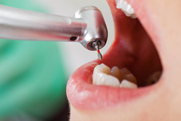 Best Emergency Dental Care for Abscessed Tooth in South El Monte, CA